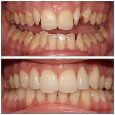 Før og etter tannregulering